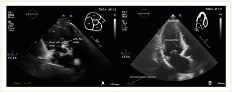 Unexpected suicide left ventricle post